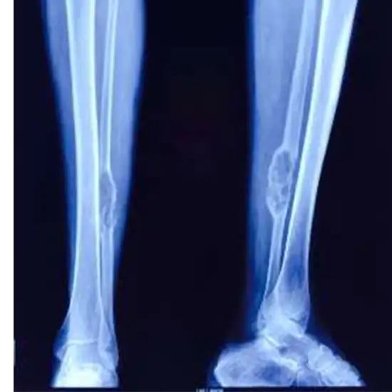 X-ray Left Leg Oblique View